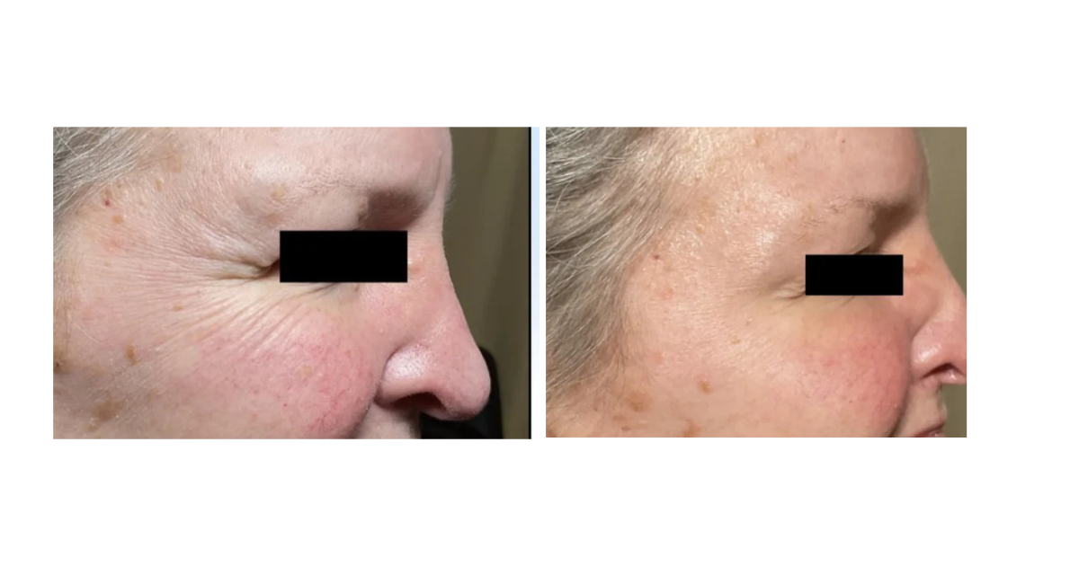 physician performing wrinkle relaxer injection treatment