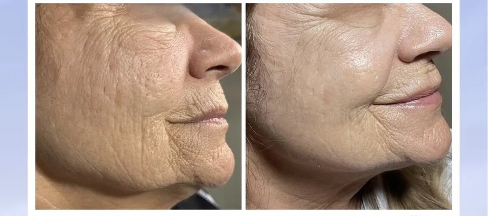 advanced radiofrequency microneedling treatment in a medical spa