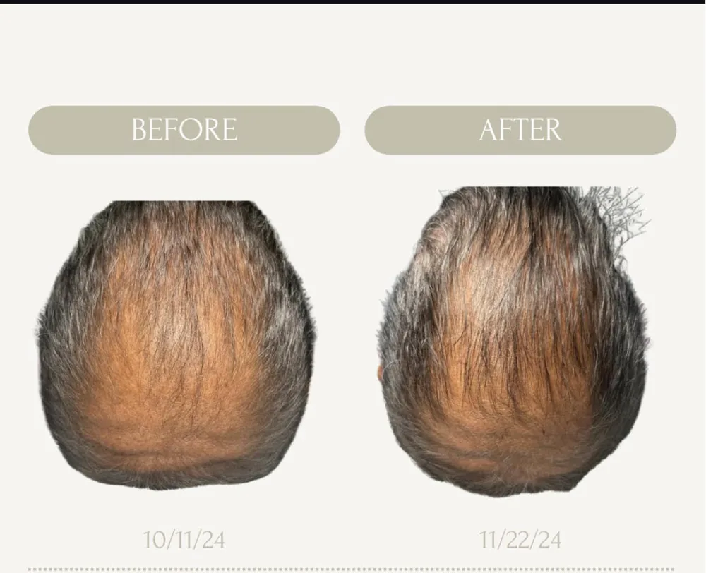 Physician performing PRP hair restoration treatment