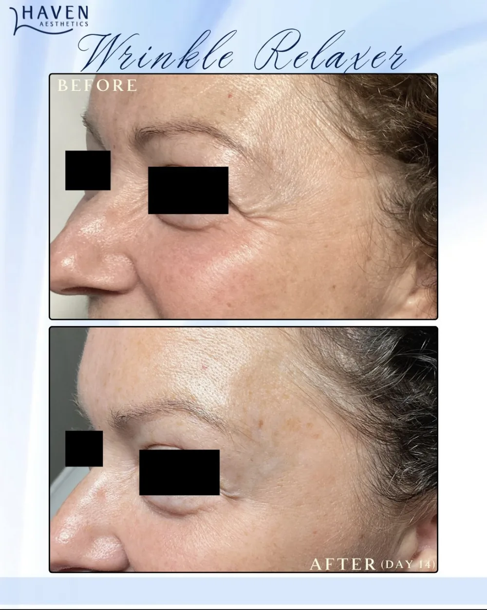 A woman receiving a precise injectable treatment administered by a physician