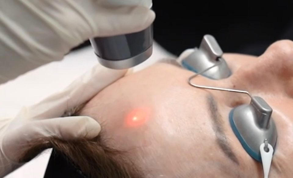 Laser treatment being applied to a person's facial skin by a medical professional