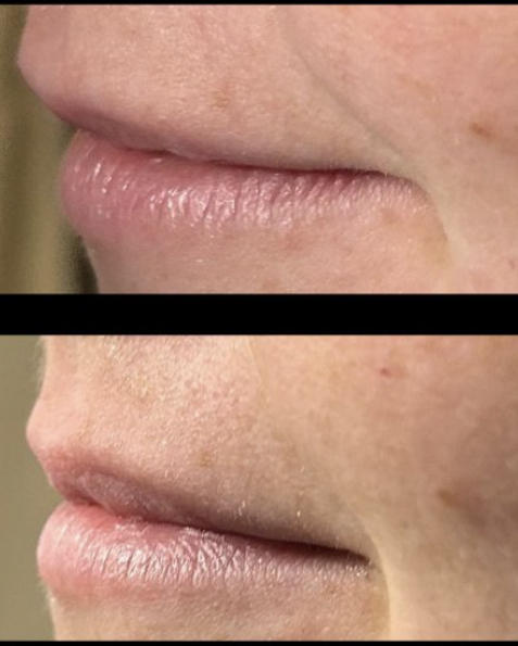 Before and after images showing natural lip fullness and texture differences