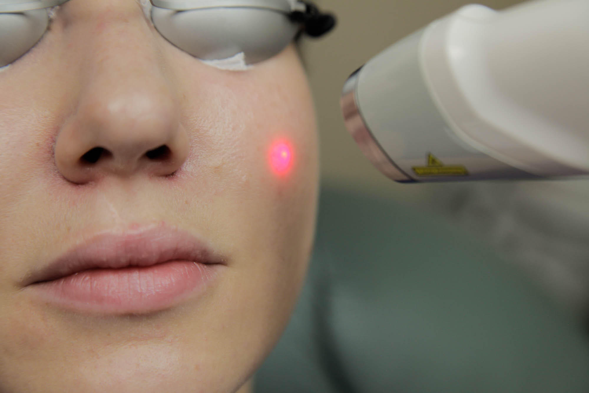 Woman undergoing laser treatment on her face, wearing protective eyewear